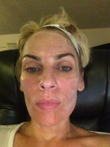 My face felt warm like I had a sunburn. and it was frosty looking.