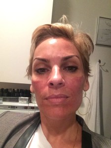 My face looked smooth and a little red like I went in the sun for 5 hours with no sunblock.